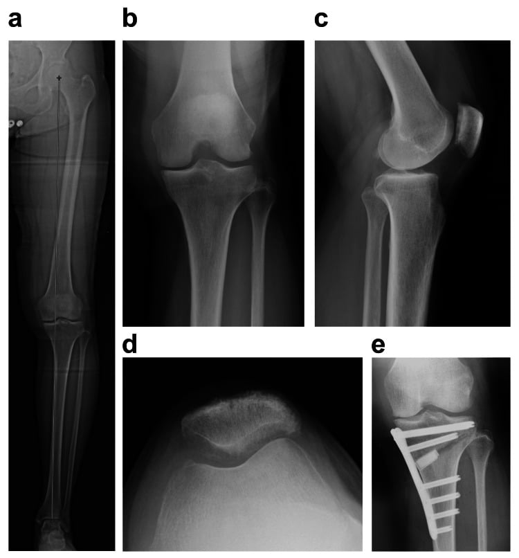 Long-leg alignment and dedicated knee radiographs in varus medial-compartment osteoarthritis, with a postoperative view after high tibial osteotomy