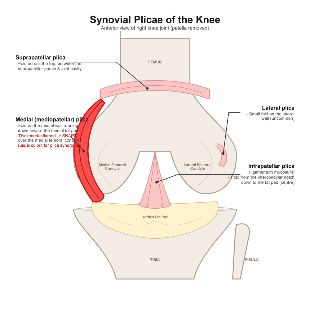 Anterior diagram of the knee interior showing the four synovial plicae - suprapatellar, medial, infrapatellar and lateral - with the thickened medial plica highlighted as it snaps over the medial femoral condyle
