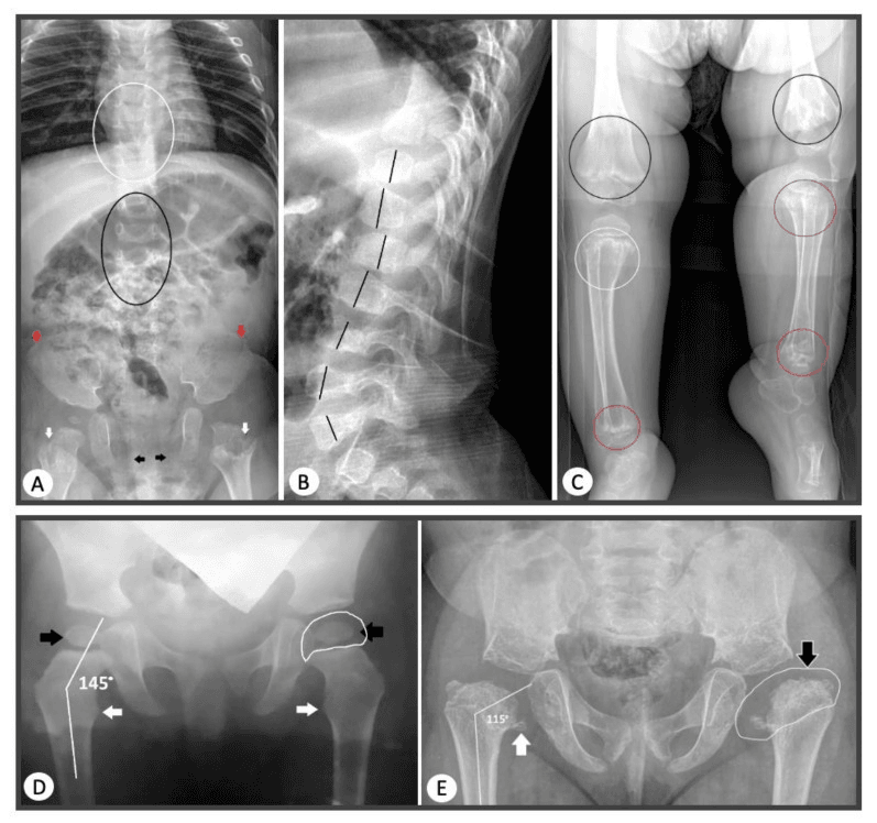 Radiographs of spine, pelvis, hips, knees and hands from probands across the COL2A1 skeletal dysplasia spectrum