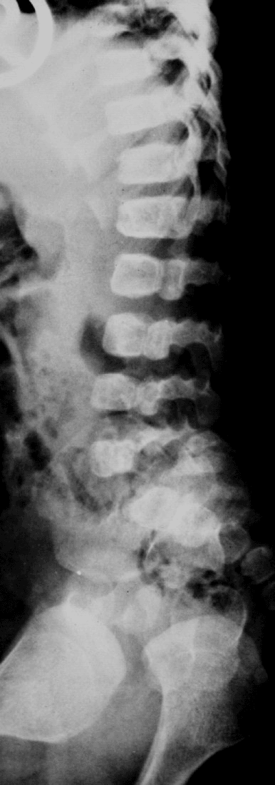 Lateral lumbar spine radiograph in Kniest dysplasia showing coronal vertebral clefts