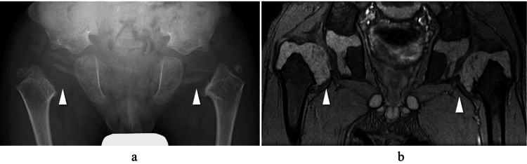 Hip radiograph and MRI of a four-year-old with spondyloepiphyseal dysplasia showing no visible femoral-head ossification centre with lateral displacement of the proximal femur