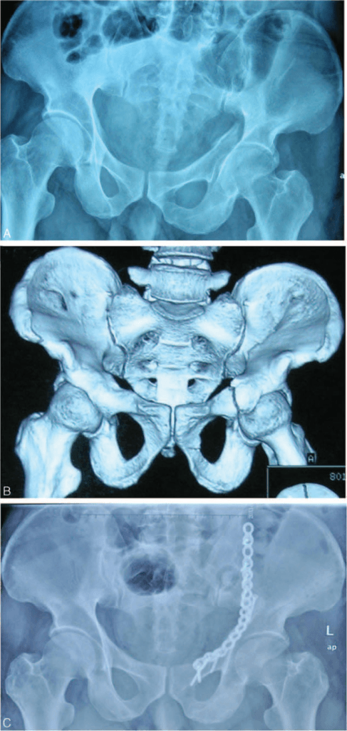 Acetabular fracture 3D CT reconstruction and radiograph