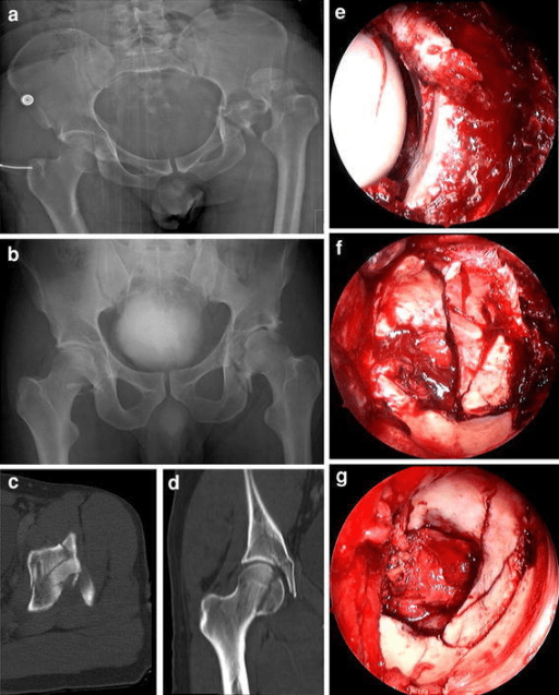 Bilateral posterior hip dislocation with acetabular fracture