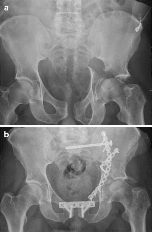 Both column acetabular fracture with pelvic ring injury