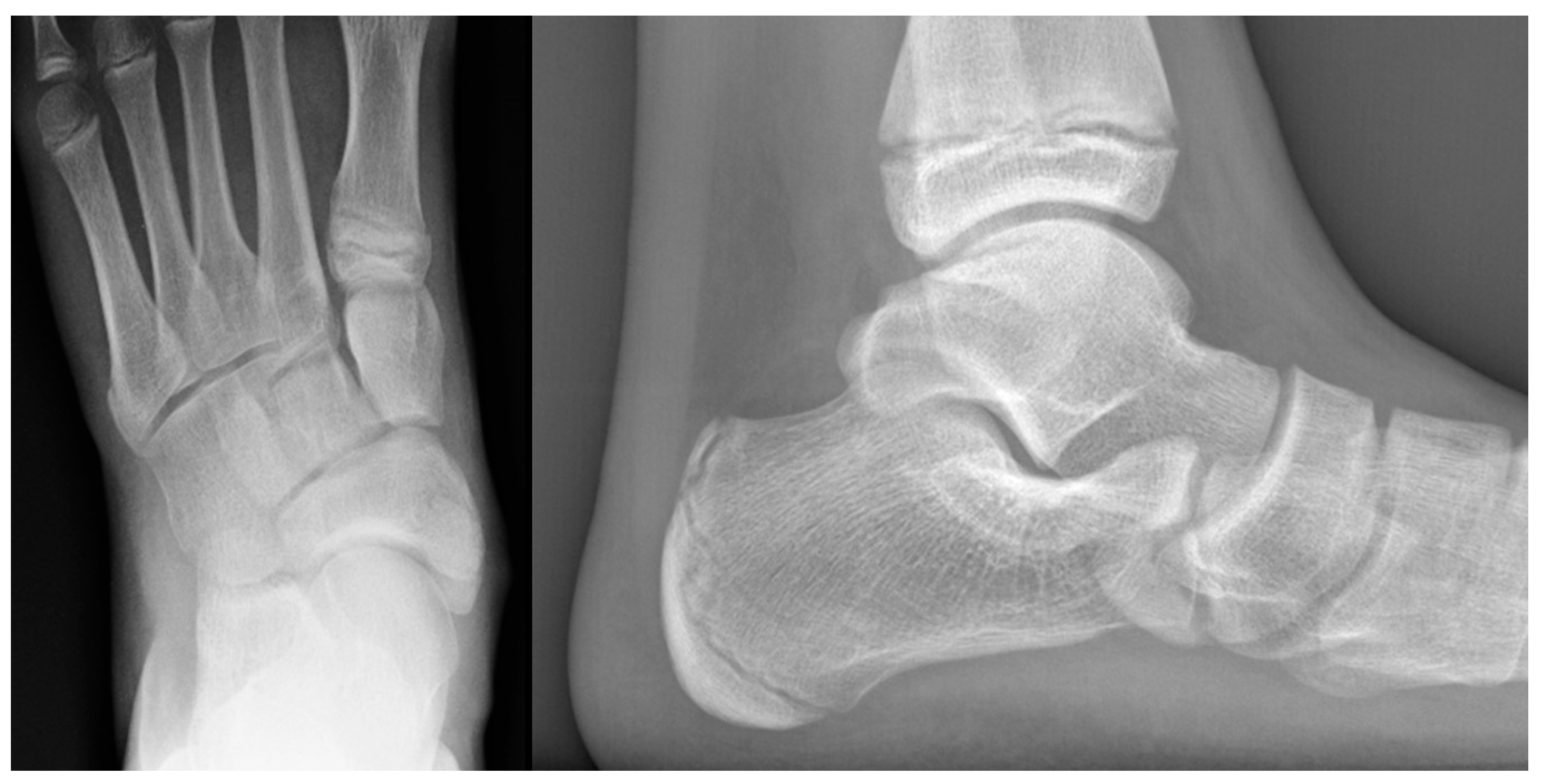AP foot radiograph and lateral hindfoot radiograph reported to show a prominent accessory navicular.