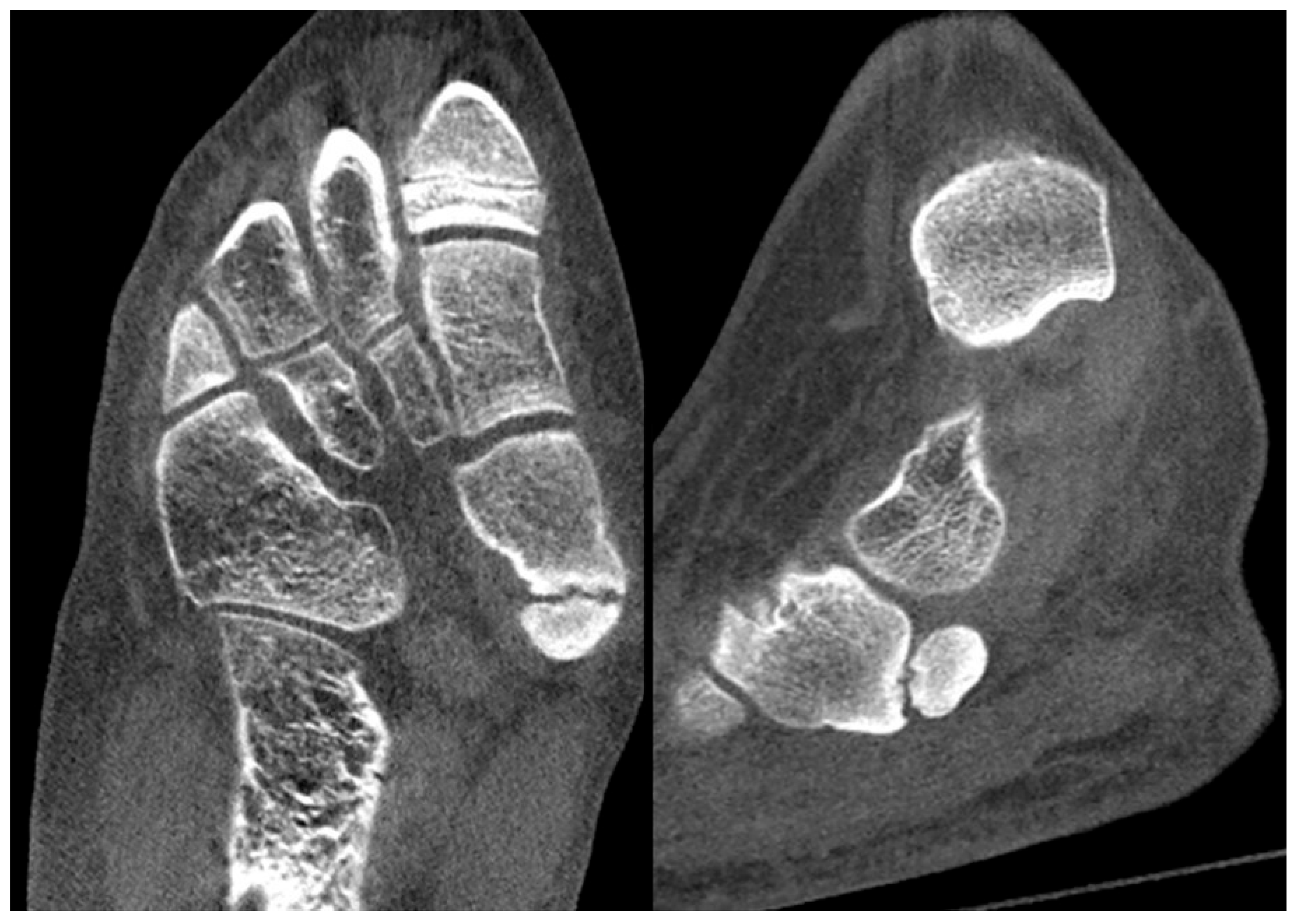 Two CT images showing a corticated accessory ossicle at the medial navicular.