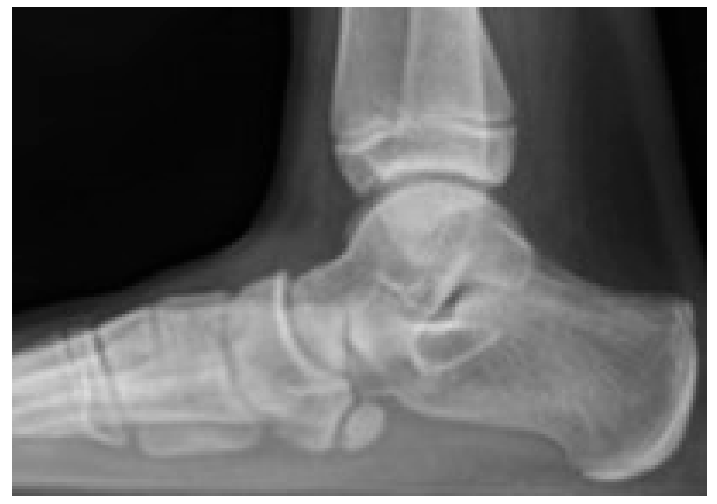 Lateral foot radiograph reported to show flatfoot with a large accessory navicular.