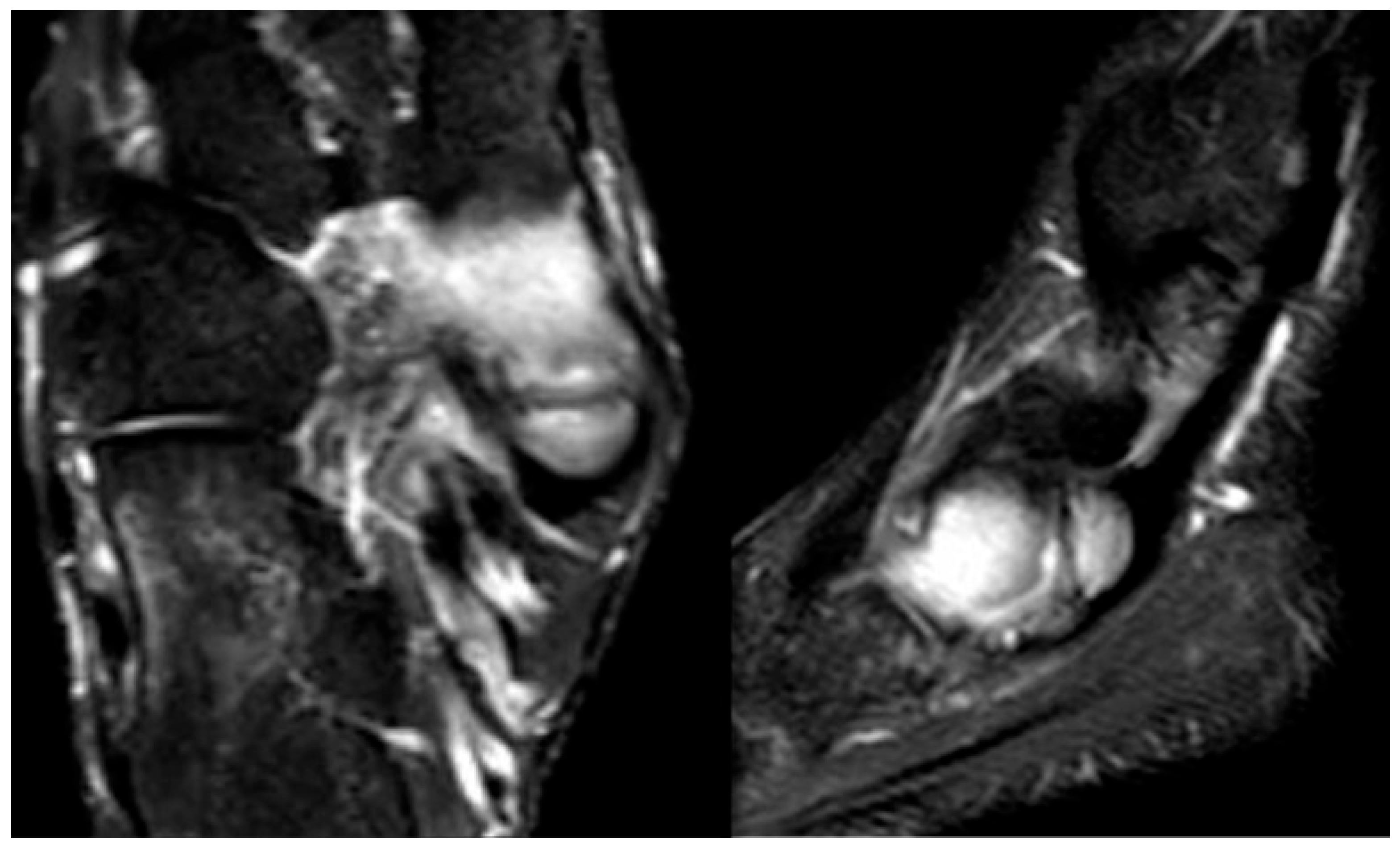 Multiplanar foot MRI showing marrow oedema in a symptomatic accessory navicular.