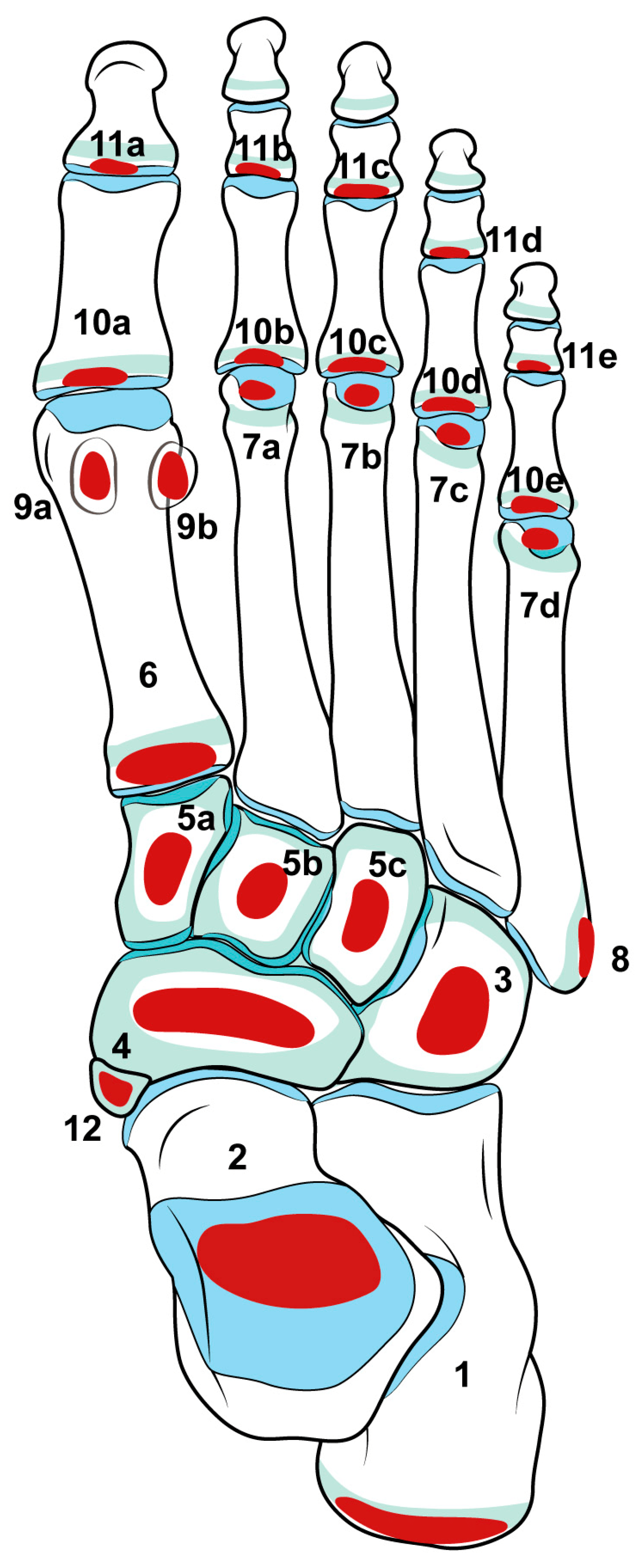 Numbered anatomical map of foot osteochondrosis sites, with the tarsal navicular labelled 4 between the talus and the cuneiforms.