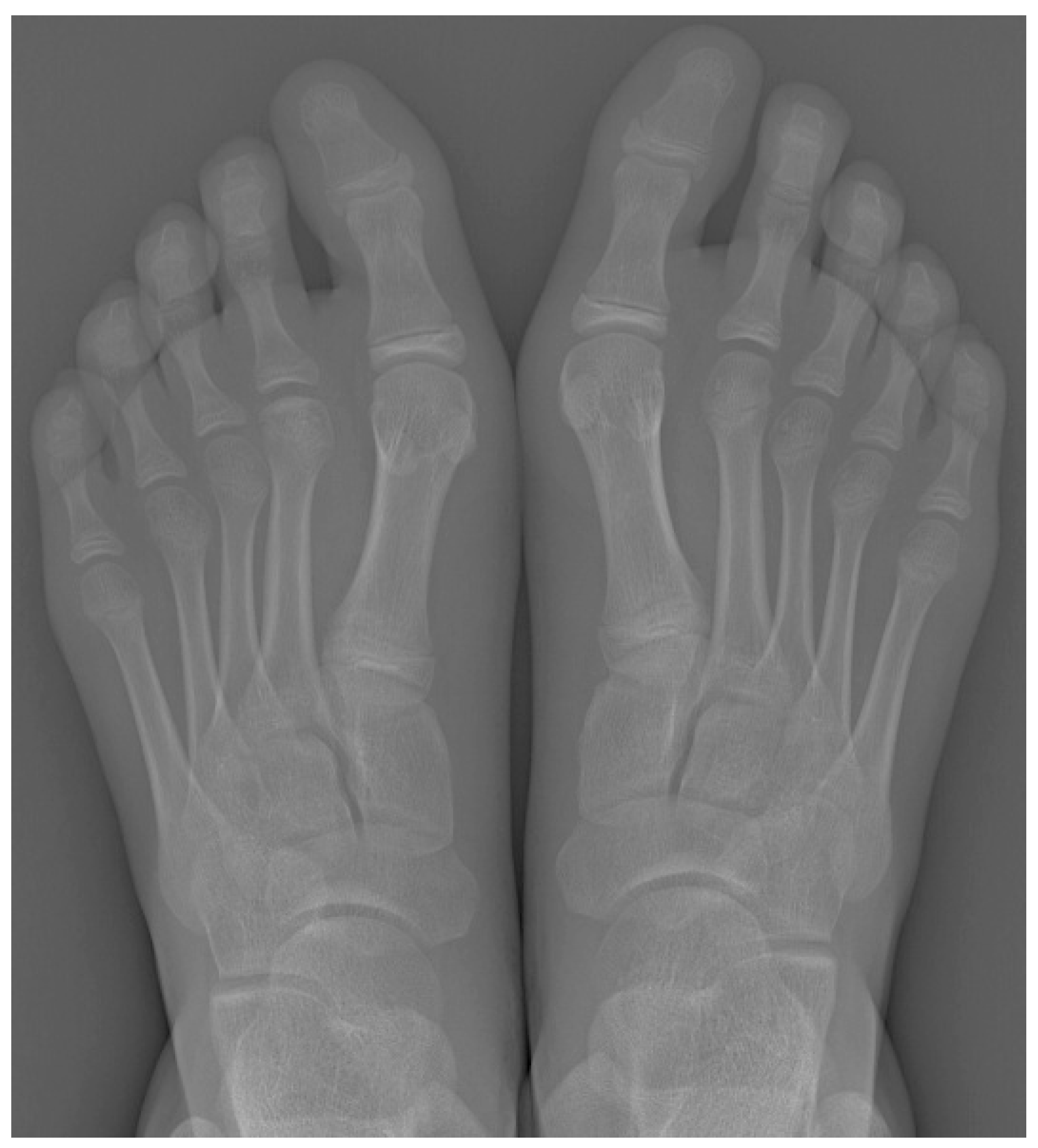 Paired foot radiographs showing early sclerosis and flattening of the second metatarsal head in Freiberg disease.