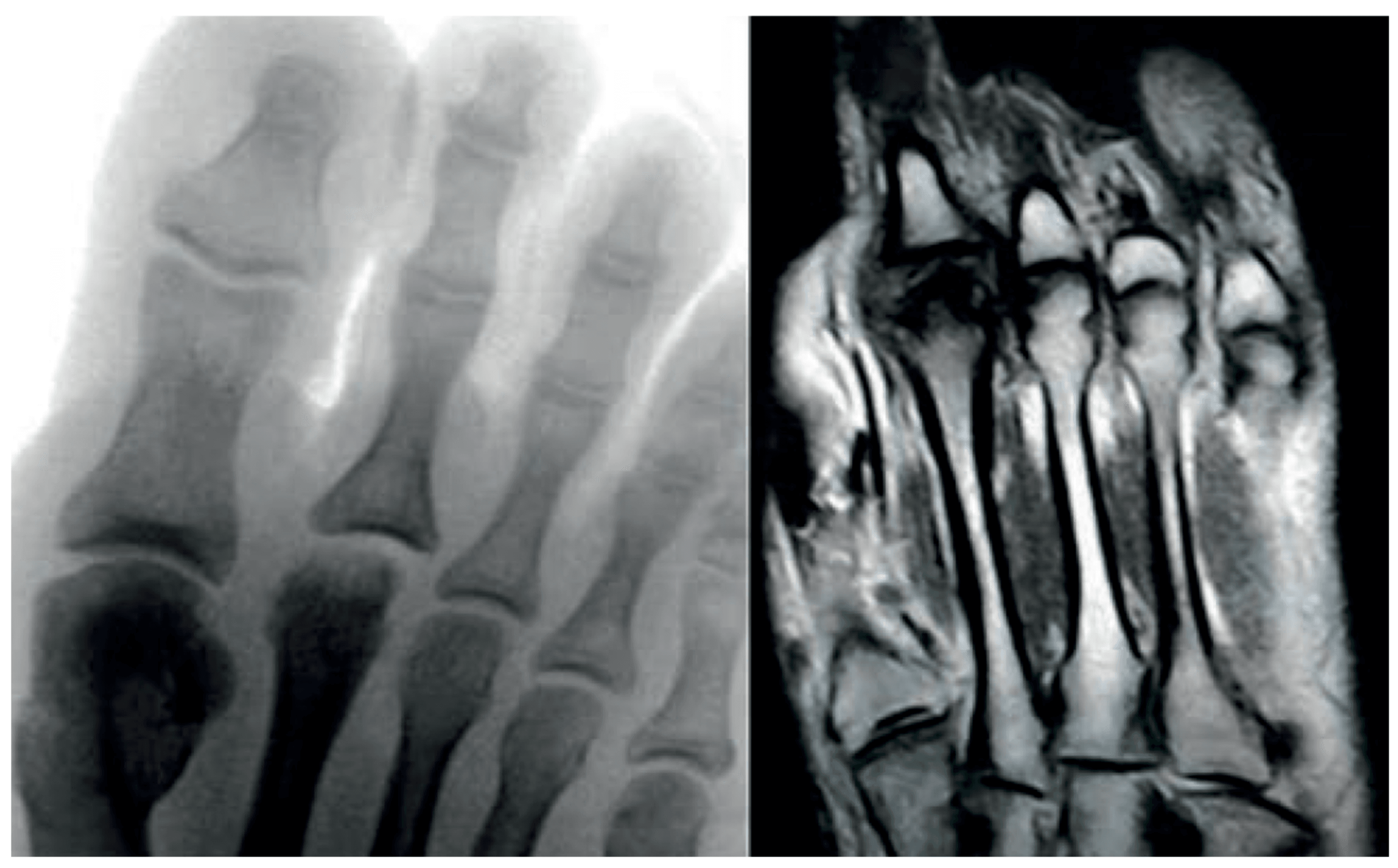 Foot radiograph and MRI showing necrosis and early flattening of the second metatarsal head.