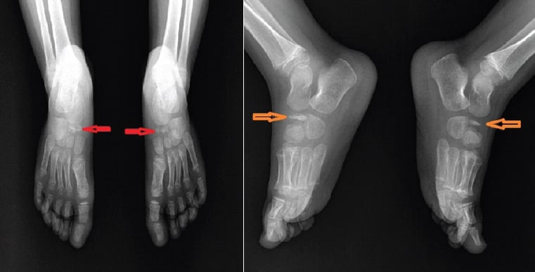 Bilateral AP foot radiographs demonstrating bilateral tarsal navicular fragmentation