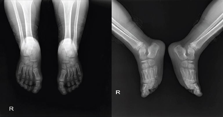 Bilateral AP foot radiographs at 1-year follow-up demonstrating navicular re-ossification