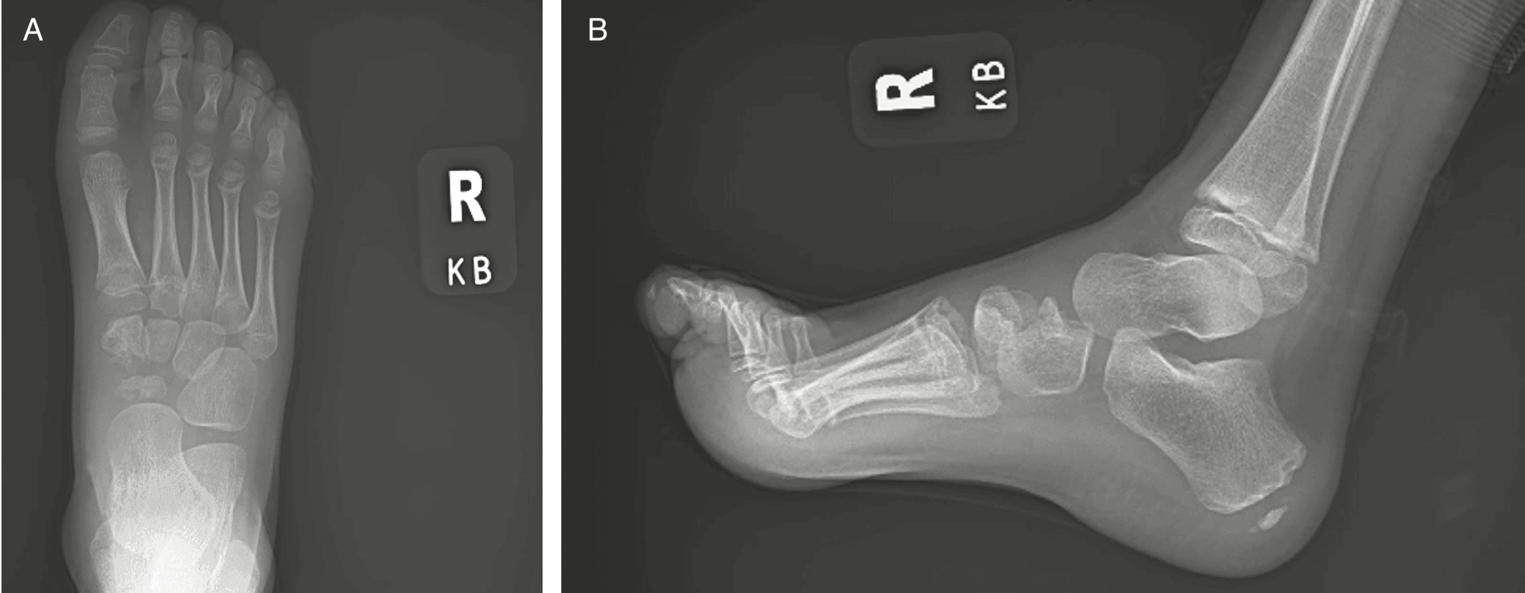 AP (A) and lateral (B) follow-up radiographs showing progressive navicular and medial-cuneiform ossification at eight weeks.