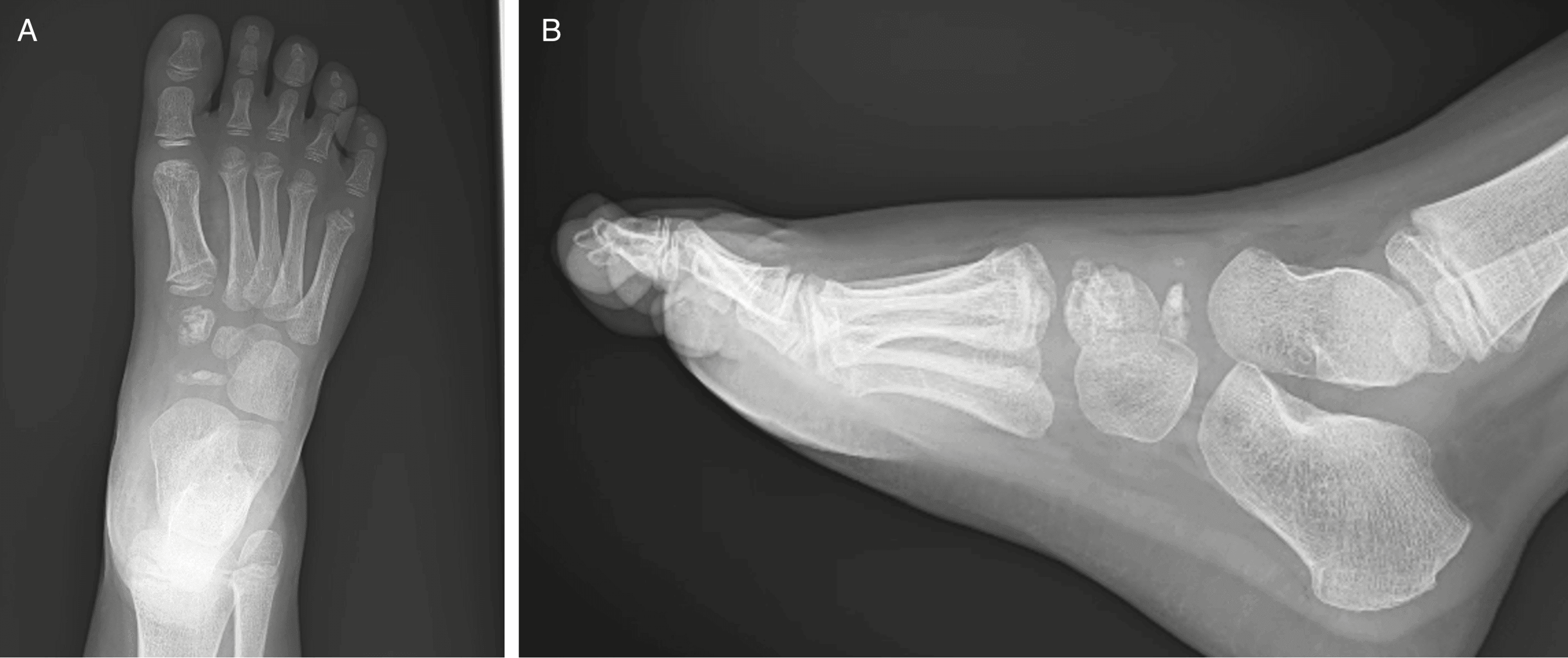 AP (A) and lateral (B) foot radiographs showing a thin sclerotic navicular and fragmented medial cuneiform.