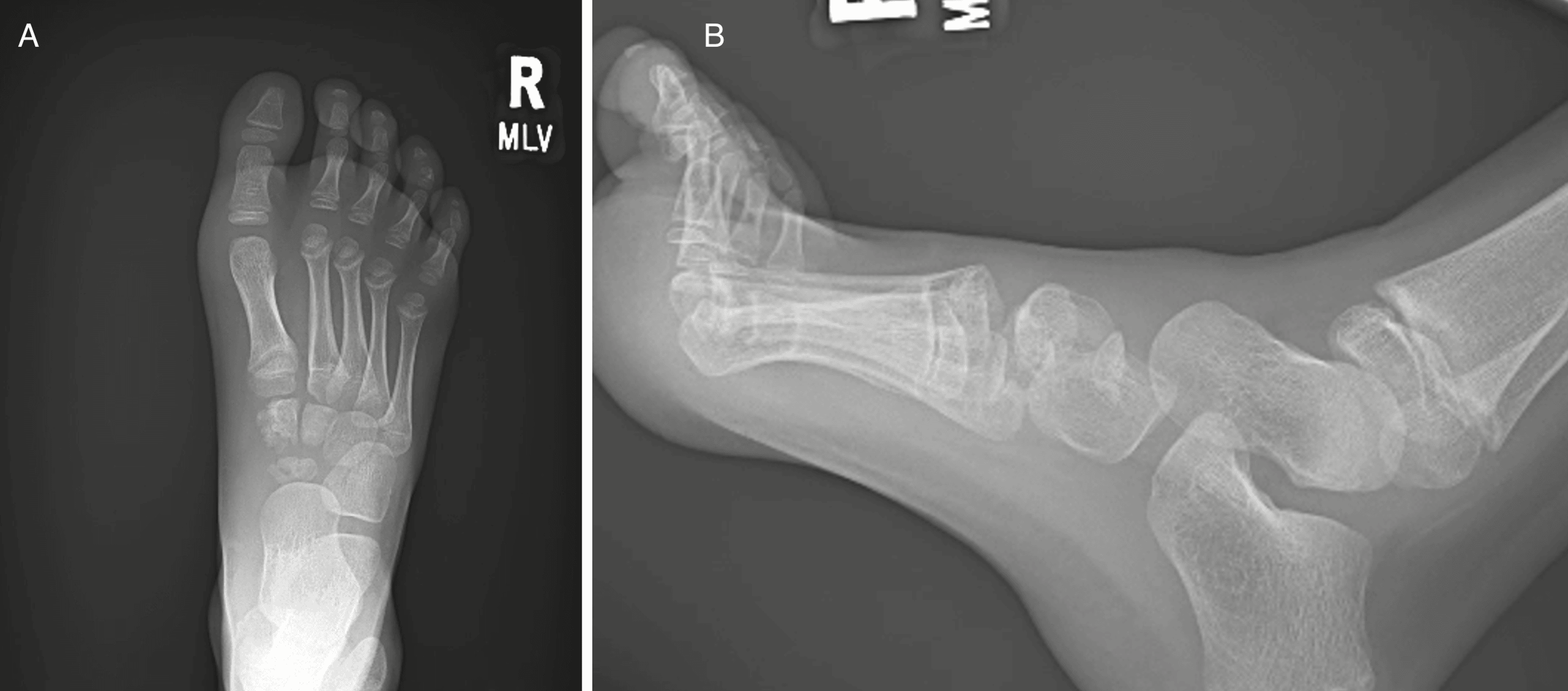 AP (A) and lateral (B) foot radiographs showing abnormal medial margins of the navicular and medial cuneiform.