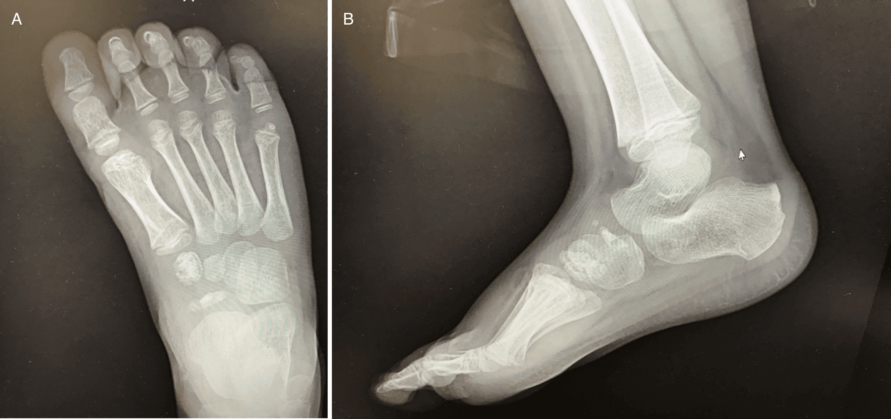 AP (A) and lateral (B) follow-up radiographs showing navicular and medial-cuneiform healing at ten weeks.