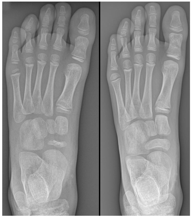 AP foot radiographs showing Kohler disease navicular collapse and its healing on follow-up