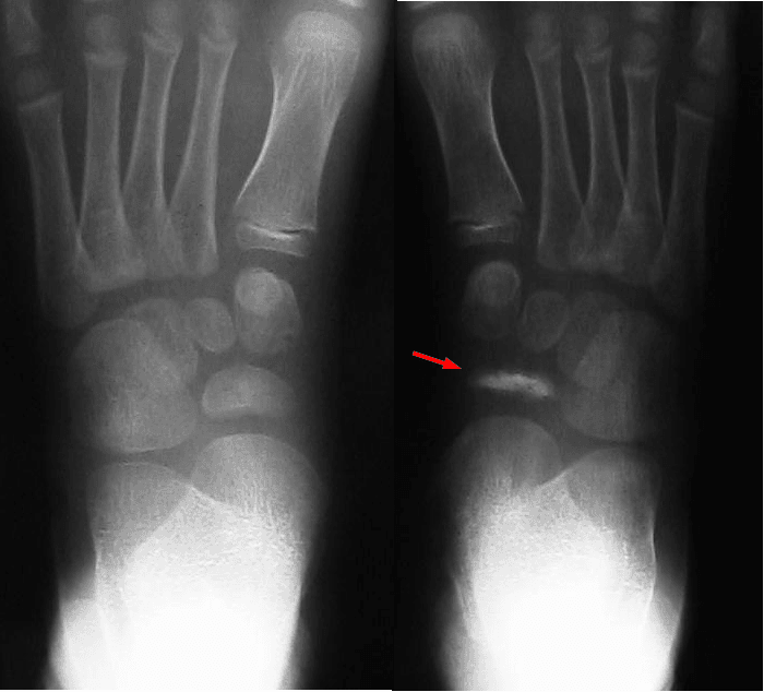 Comparison AP foot radiographs in Köhler disease: the affected tarsal navicular is sclerotic, flattened and narrowed compared with the normal contralateral side.
