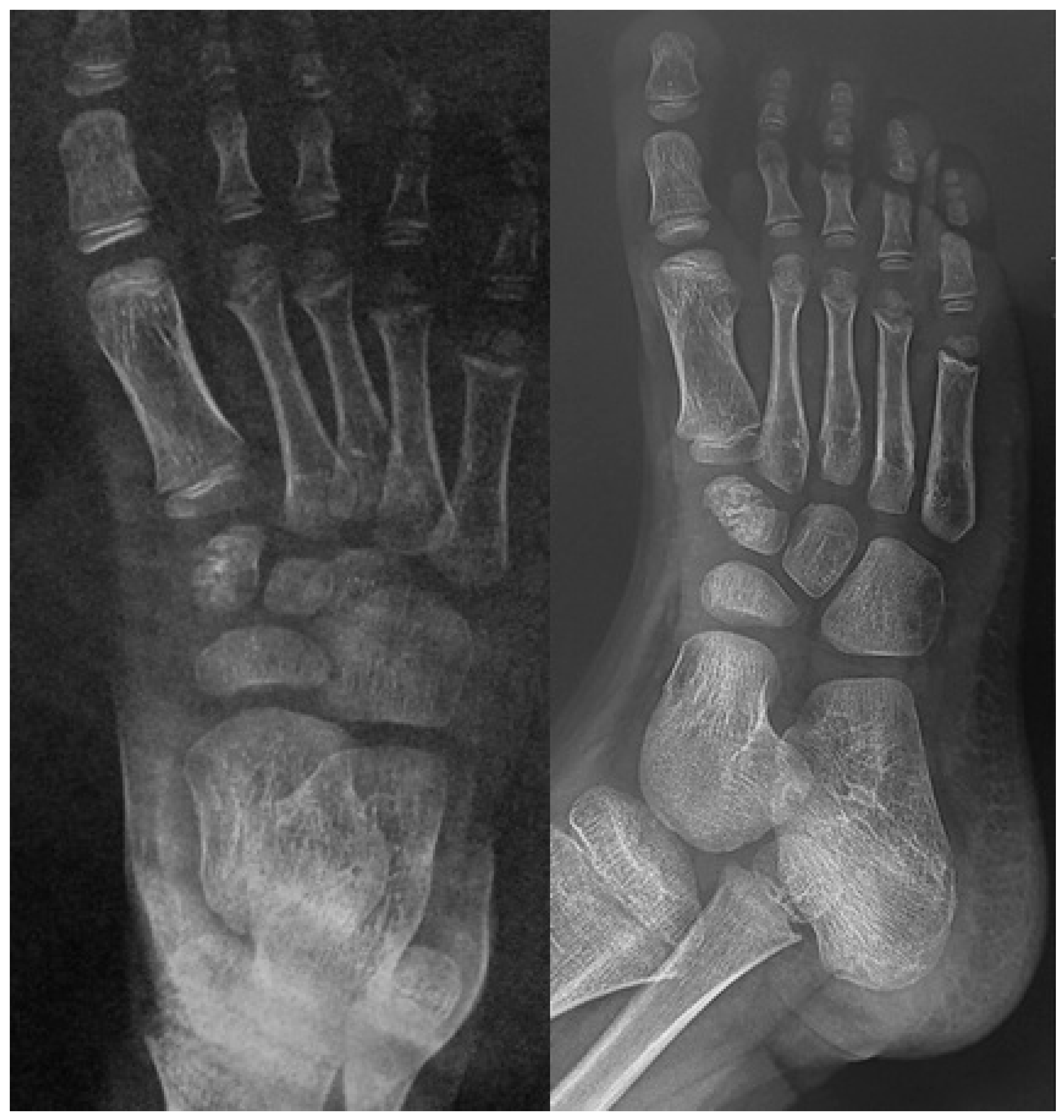 Two foot radiographs showing fragmentation and irregular margins of the medial cuneiform.