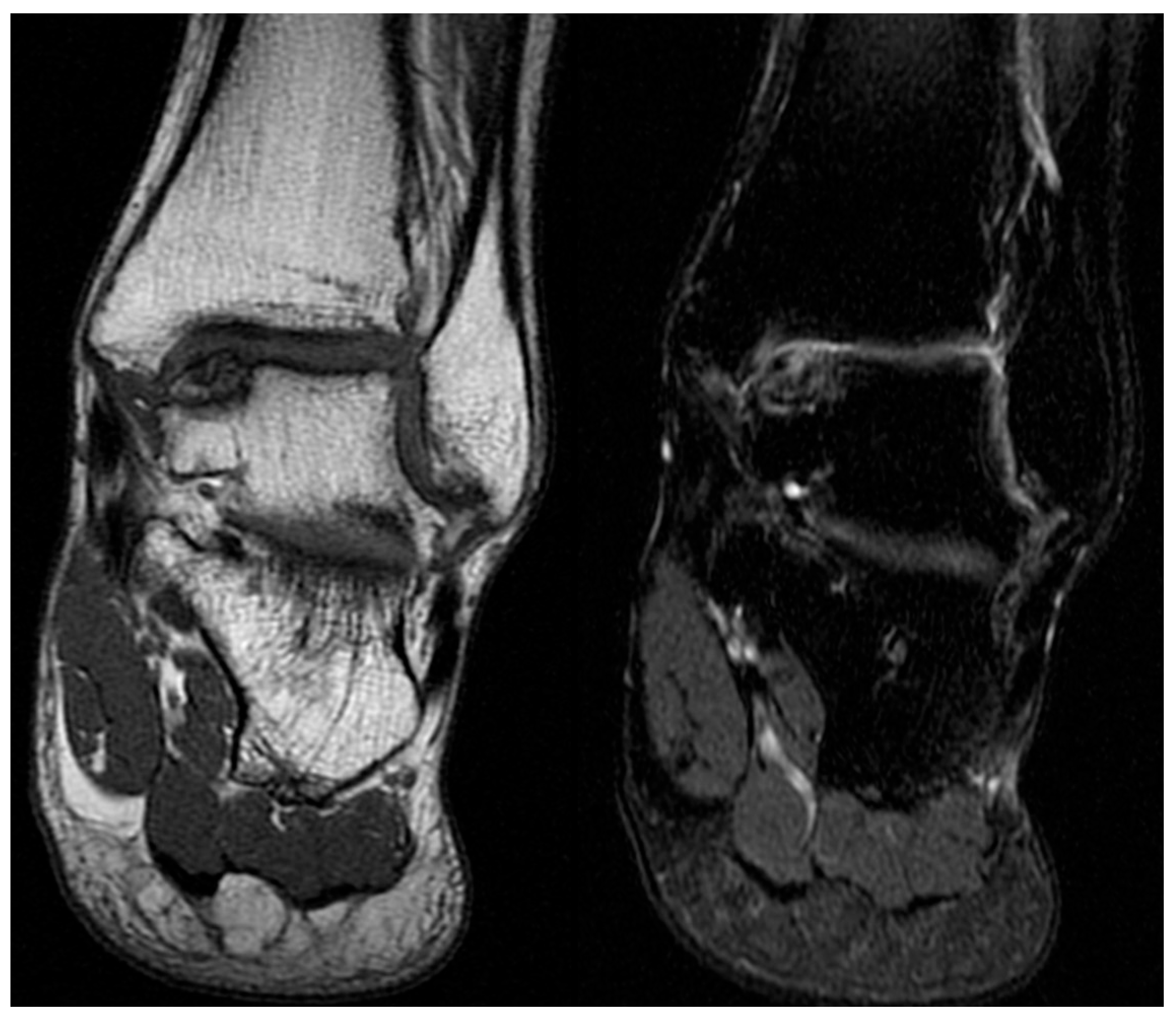 Paired ankle MRI images showing osteochondritis dissecans of the medial talar dome.
