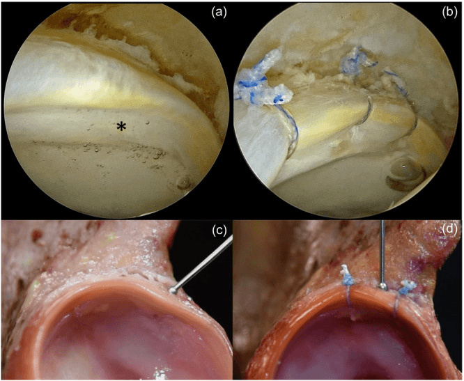 Arthroscopic bubble sign and restoration after labral repair