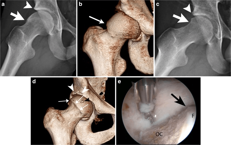 Radiograph and CT before and after cam osteochondroplasty