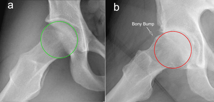 Dunn radiographs comparing normal and cam hip morphology