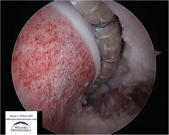 Circumferential allograft reconstruction forming an anatomic seal