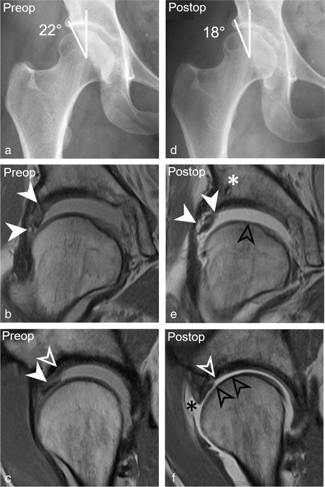 Radiographs and MRI showing dysplasia with labral tear and paralabral cyst