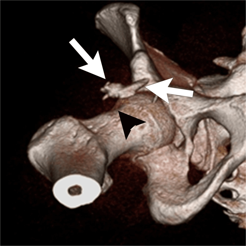 CT showing heterotopic ossification after hip arthroscopy