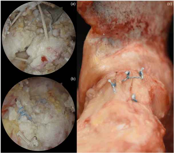 Arthroscopic watertight capsular closure