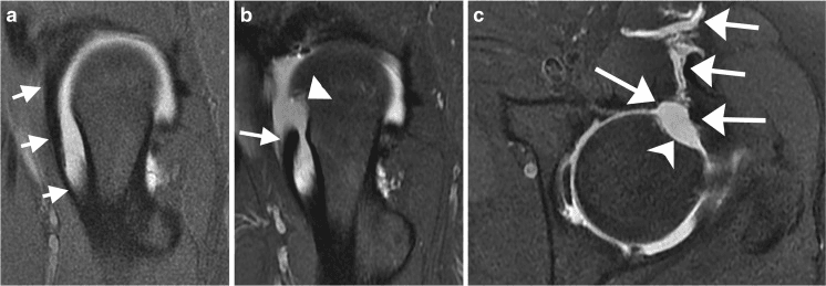 MR arthrogram showing capsular discontinuity after hip arthroscopy