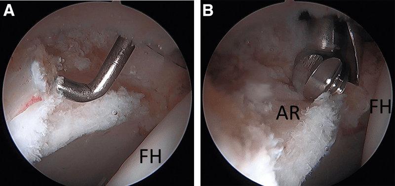 Arthroscopic sizing of an irreparable acetabular labral defect