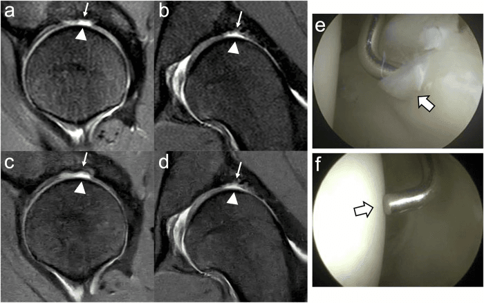 MRI and arthroscopy comparison illustrating false-positive interpretation