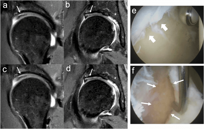 MRI and arthroscopy showing a true chondrolabral defect