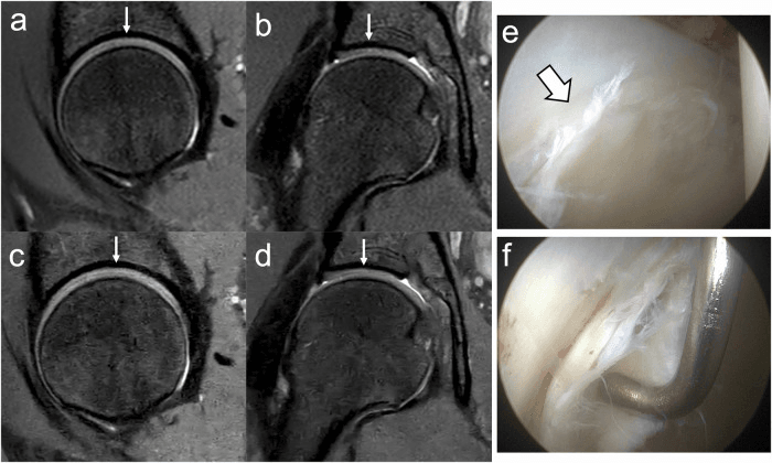 MRI false negative with arthroscopically proven labral tear