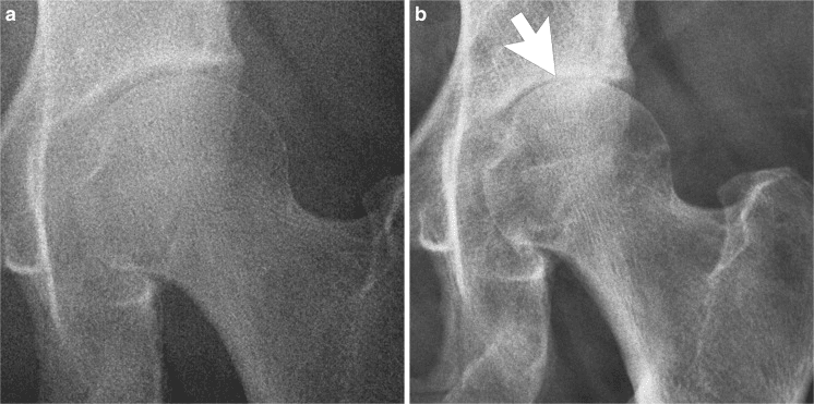 Serial radiographs showing rapid postoperative hip chondrolysis