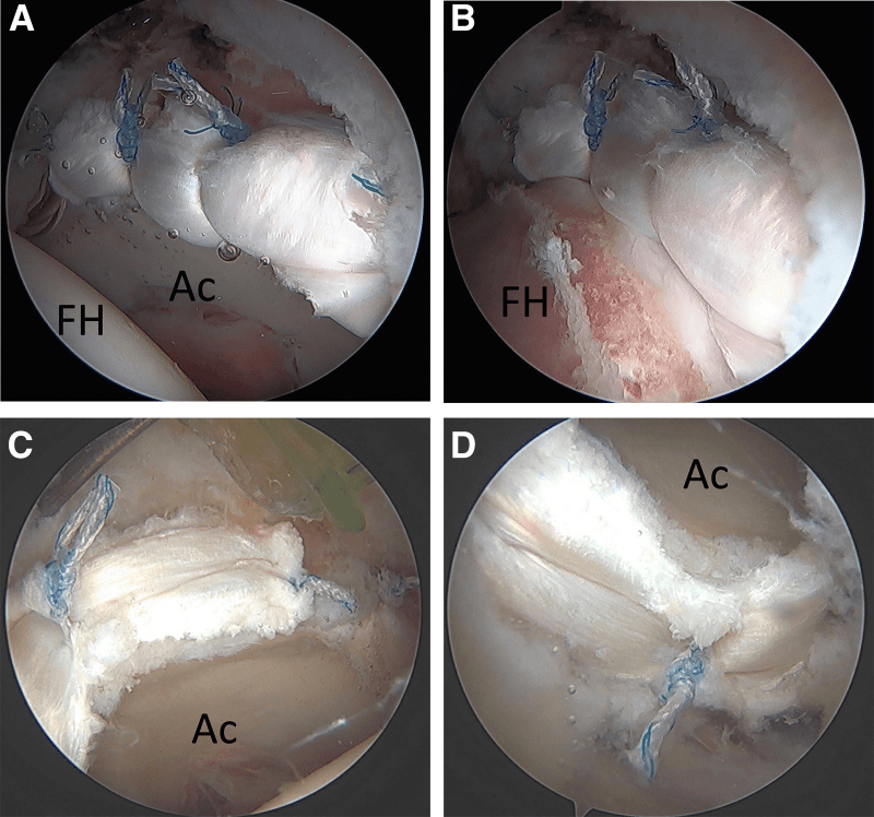 Segmental labral reconstruction with restored suction seal