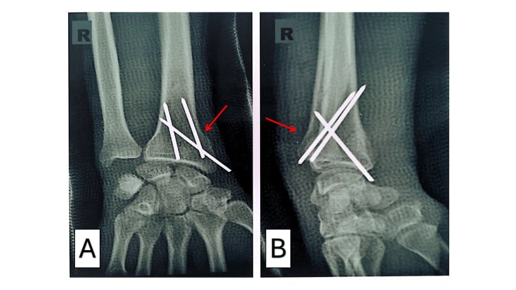 Two wrist radiographs marked R showing a distal radius held with three crossed Kirschner wires