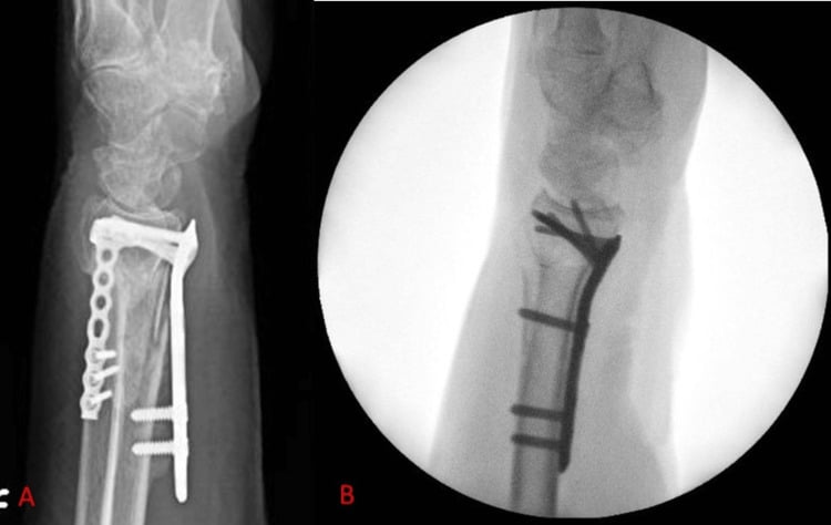 Lateral distal radius radiograph and fluoroscopic image showing a volar locking plate