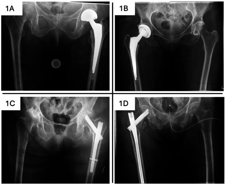 Four hip radiographs labelled 1A to 1D showing a hemiarthroplasty, a total hip arthroplasty, a short cephalomedullary nail and a long cephalomedullary nail
