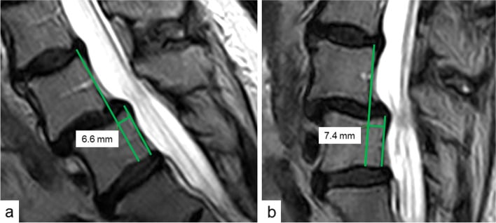 Two sagittal lumbar MRI panels, a and b, with a measured vertebral translation of 6.6 mm and 7.4 mm