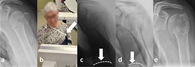Five-panel figure of a proximal humerus fracture treated non-operatively, with radiographs, a patient in a sling and follow-up images