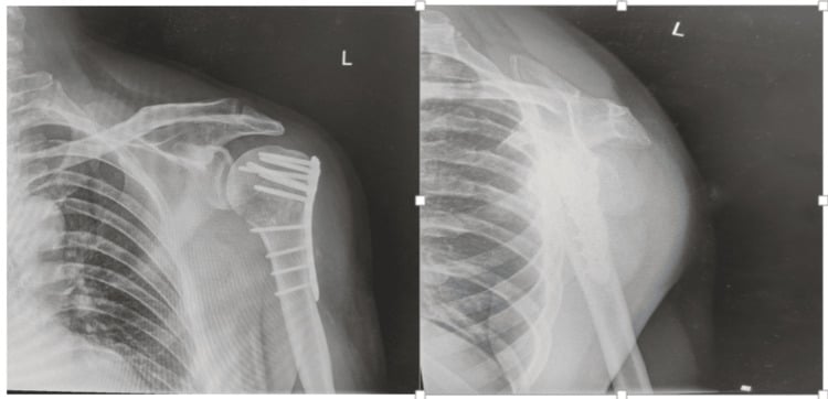 Two radiographs of the left shoulder after plate and screw fixation of a proximal humerus fracture