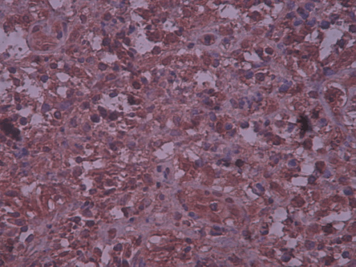 Langerhans cell histiocytosis of the bone. Immunohistochemical positive reaction with S100 in bone lesion ×10.