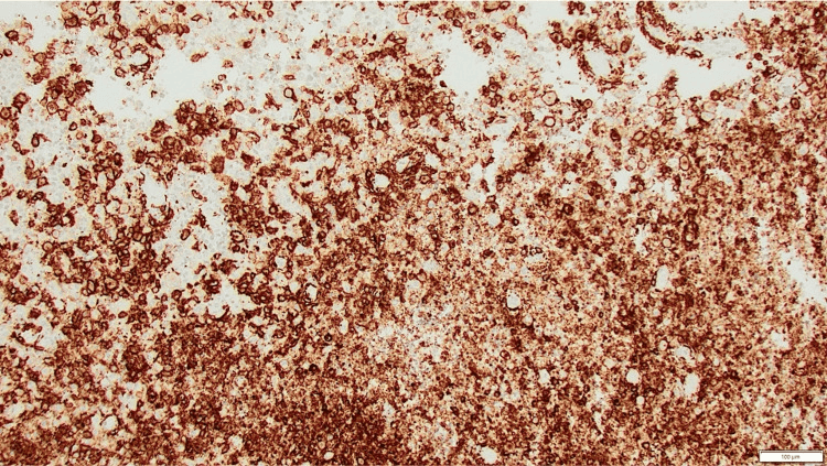 CD1a immunohistochemistry showing strong positivity in LCH lesional cells