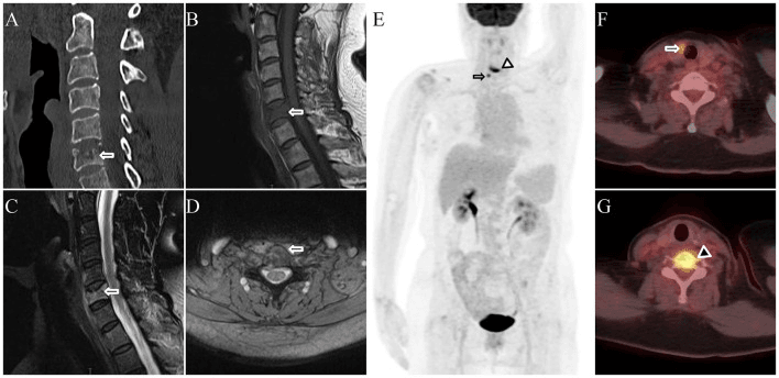 Multimodality CT MRI and FDG PET imaging of LCH involving the C6 vertebral body