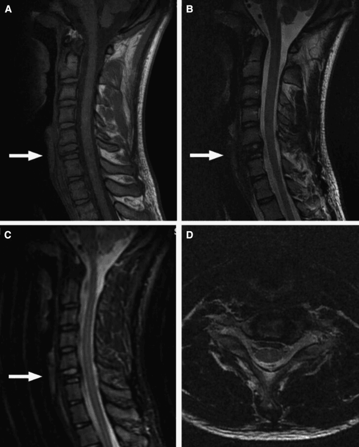 Sagittal and axial cervical MRI demonstrating near-complete collapse of the C6 vertebral body with preservation of the spinal cord