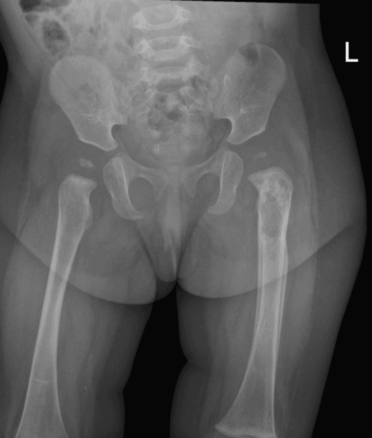 Follow-up pelvic radiograph showing sclerosis and periosteal new bone at a healing proximal femoral LCH lesion